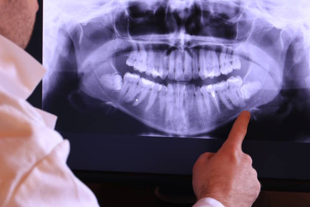 Best Emergency Wisdom Teeth Removal in Etowah, NC